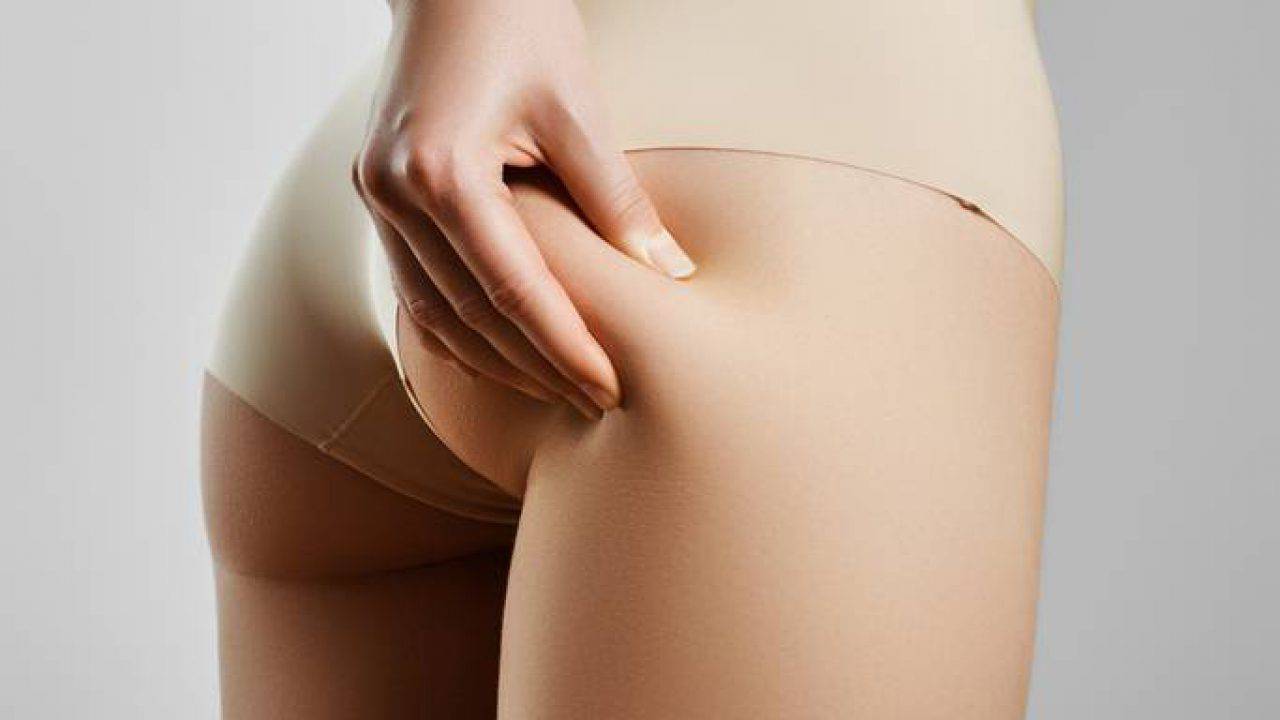 cellulite sotto i glutei