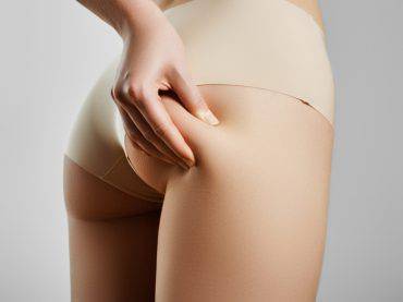 cellulite sulle cosce