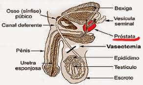 vasectomia e interruttore