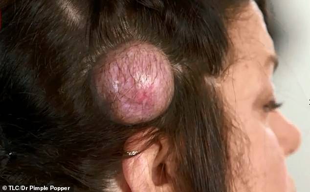 https://www.viagginews.com/wp-content/uploads/2020/05/16770350-7310603-Speaking_of_the_largest_golf_ball_like_cyst_on_her_head_pictured-m-23_1564668139191.jpg
