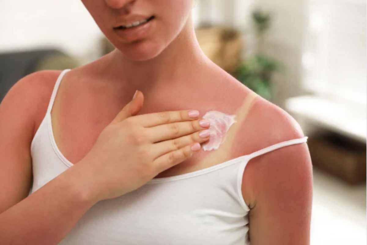 Donna che passa crema dopo sole sulla scottatura
