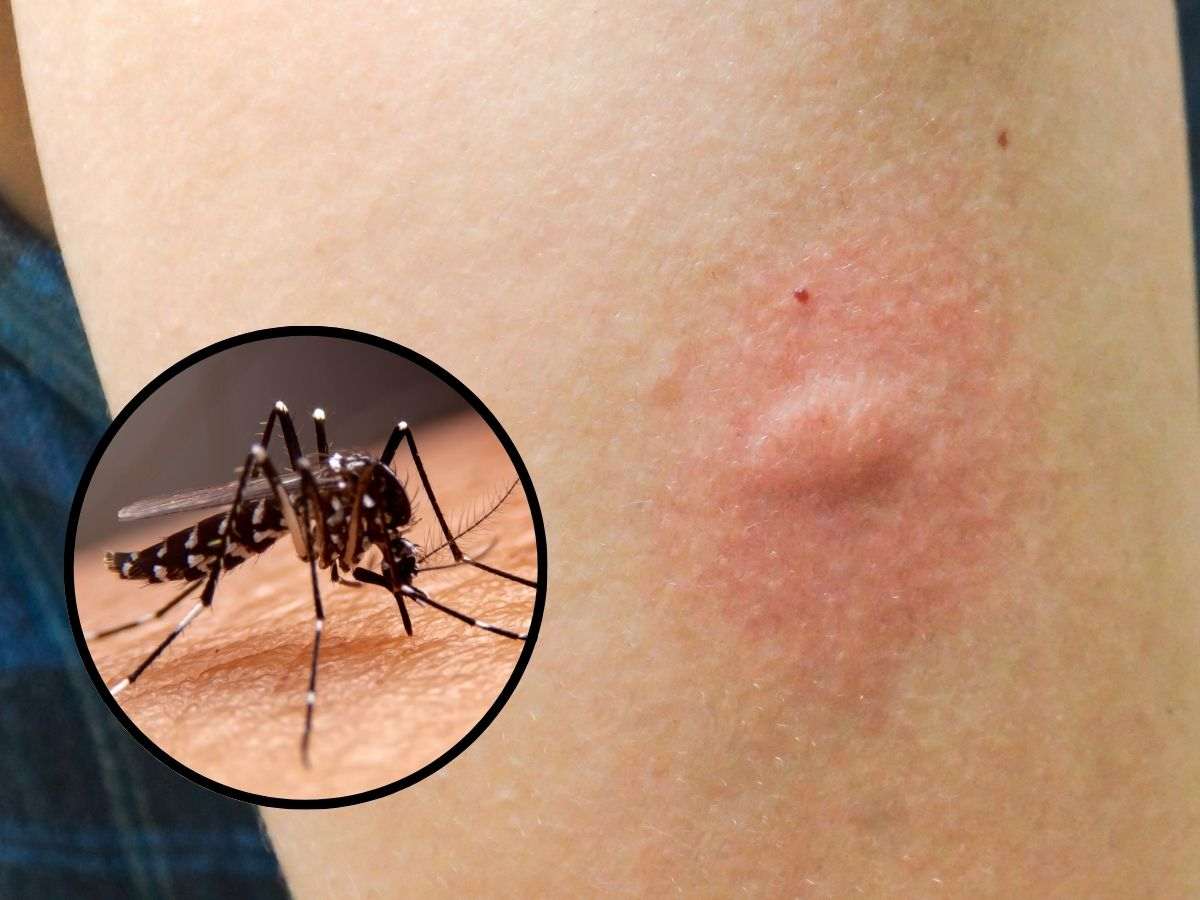 sfondo morso di zanzara e tondo con zanzara