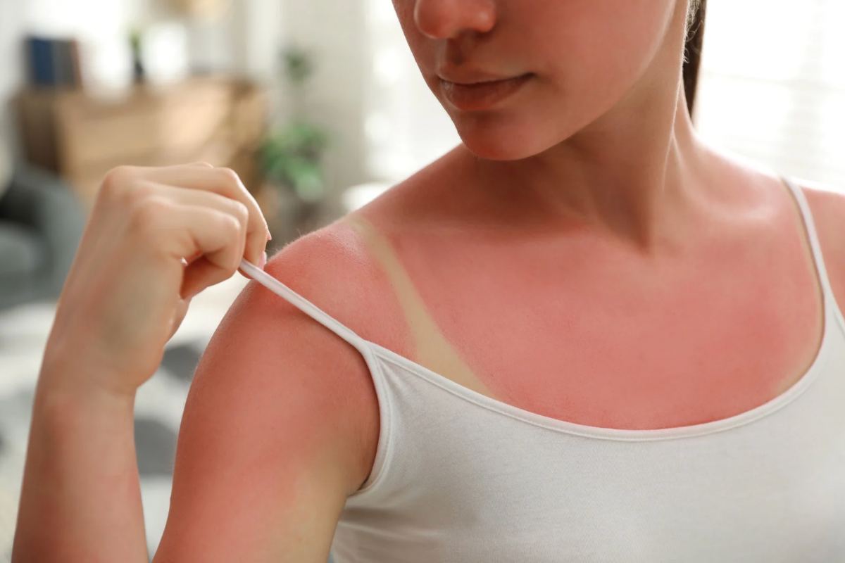 Donna con eritema solare che si abbassa la spallina della canottiera