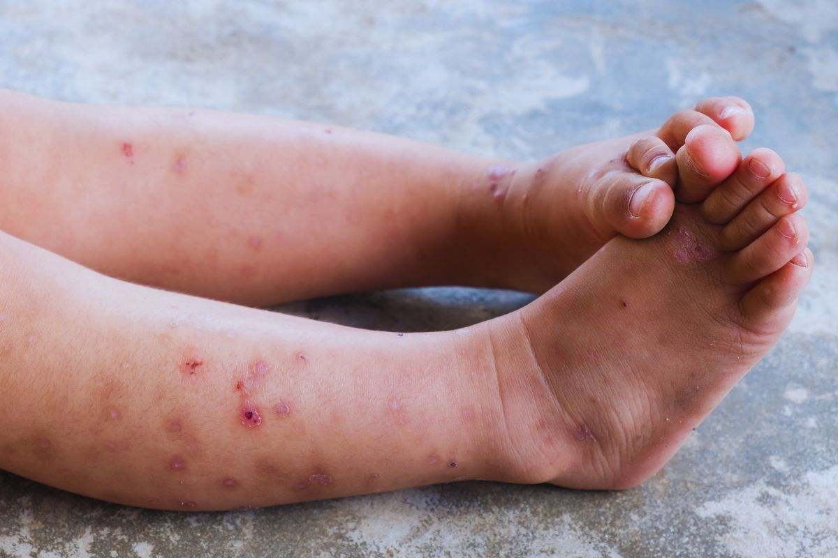 Gambe di un bimbo che mostra segni di dermatite atopica