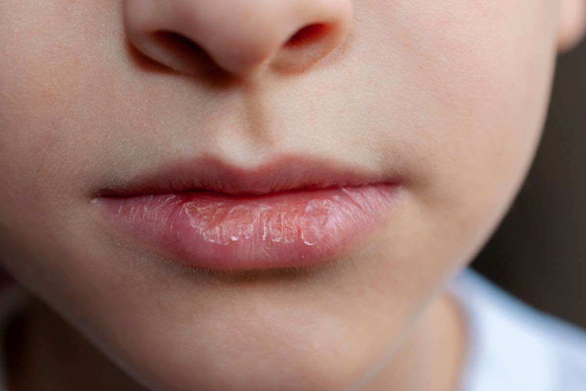 Labbra secche
